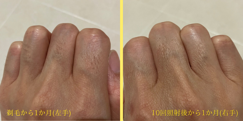 10回照射時に剃毛をした指毛（左指）と10回照射から1カ月後の指毛（右指）の比較写真