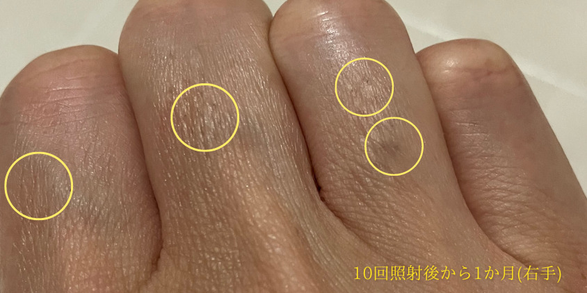 10回照射から1カ月後の指毛（右指）をアップした写真